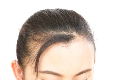 Sağlık hizmetleri şampuanı ve güzellik ürünleri konsepti için kadın ciddi saç kaybı sorunu