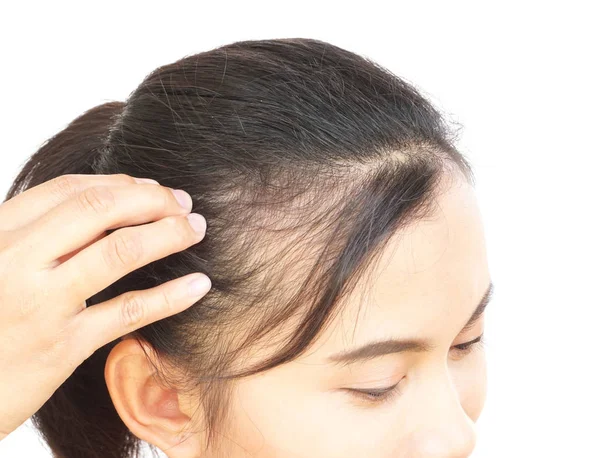 Mulher Grave Problema Perda Cabelo Para Shampoo Cuidados Saúde Conceito — Fotografia de Stock