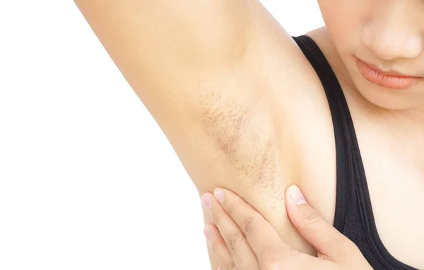 Women Problem Black Armpit White Background Skin Care Beauty Concept — Stock Photo, Image