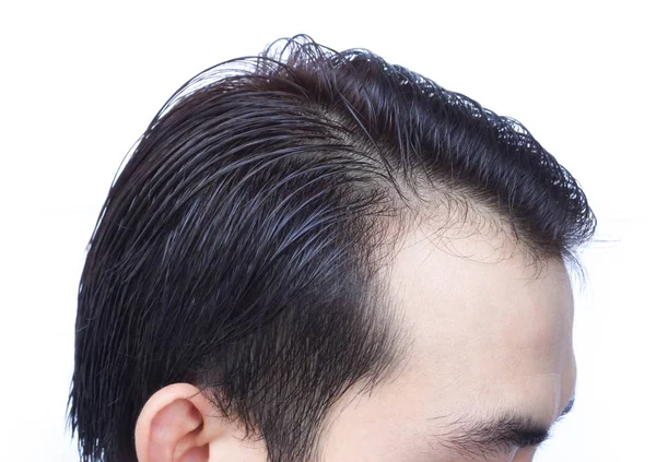 Młody Człowiek Poważny Problem Wypadania Włosów Dla Opieki Zdrowotnej Medycznej — Zdjęcie stockowe