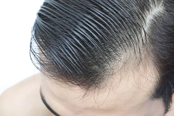 Молодой Человек Серьезная Проблема Выпадения Волос Здравоохранения Медицинской Концепции Шампуня — стоковое фото