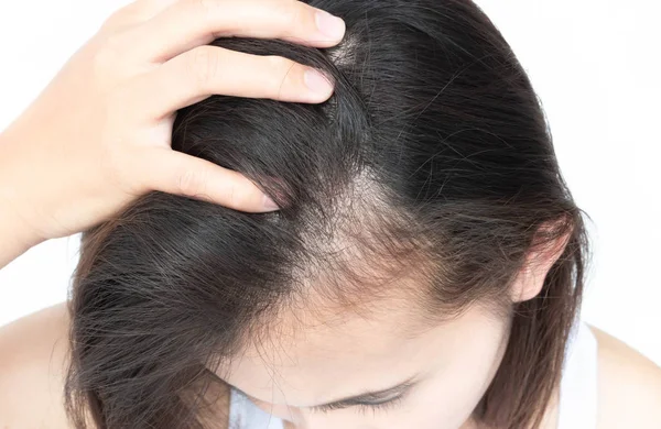 Mulher Grave Problema Perda Cabelo Para Shampoo Cuidados Saúde Conceito — Fotografia de Stock