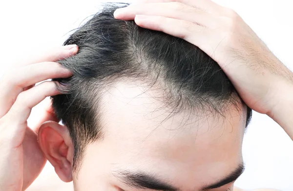 Joven Hombre Serio Problema Pérdida Cabello Para Cuidado Salud Champú — Foto de Stock