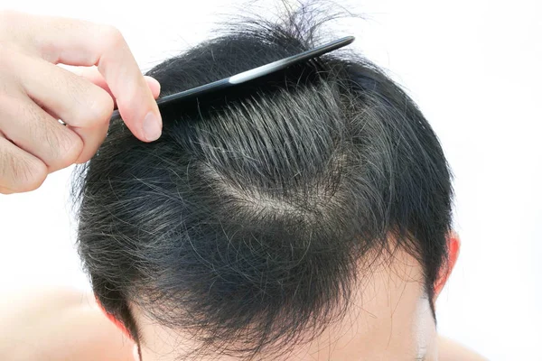Homem Jovem Grave Problema Perda Cabelo Para Cuidados Saúde Shampoo — Fotografia de Stock