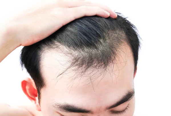 Young Man Serious Hair Loss Problem Health Care Medical Shampoo — Stock Photo, Image