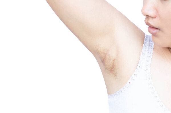 Женская проблема черные подмышки на белом фоне для ухода за кожей и концепция красоты