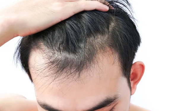 Young Man Serious Hair Loss Problem Health Care Medical Shampoo — Stock Photo, Image