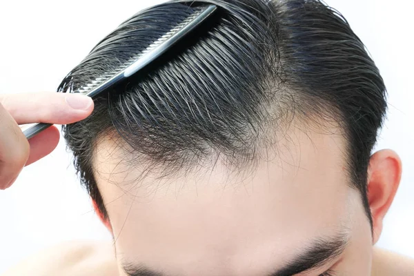 Молодой Человек Серьезная Проблема Выпадения Волос Здравоохранения Медицинской Концепции Шампуня — стоковое фото