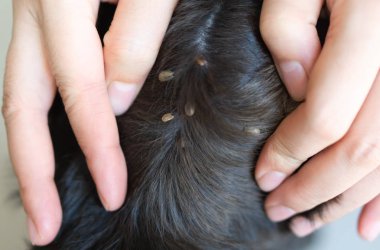 Closeup el gösteren büyük kene parazit bir köpek cilt seçici odak üzerinde