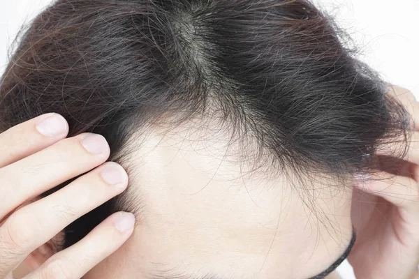 Joven hombre serio problema de pérdida de cabello para el cuidado de la salud médico y champú concepto de producto — Foto de Stock