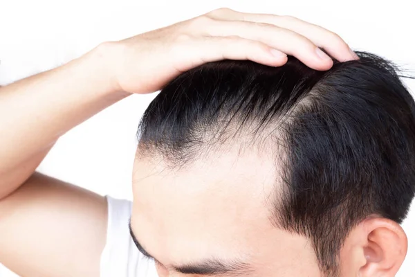 Junger Mann ernstes Haarausfall-Problem für Gesundheitswesen medizinisches und Shampoo-Produktkonzept — Stockfoto