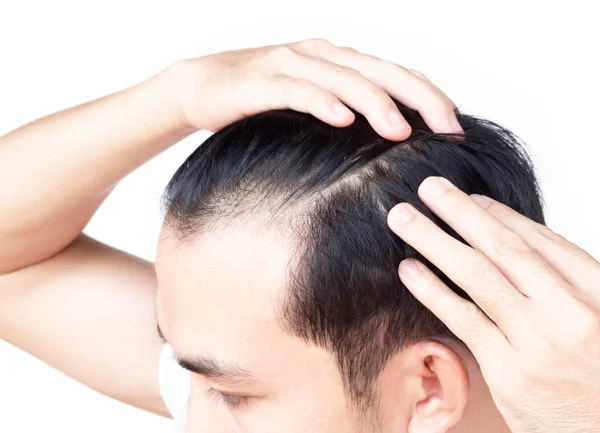 Junger Mann ernstes Haarausfall-Problem für Gesundheitswesen medizinisches und Shampoo-Produktkonzept — Stockfoto