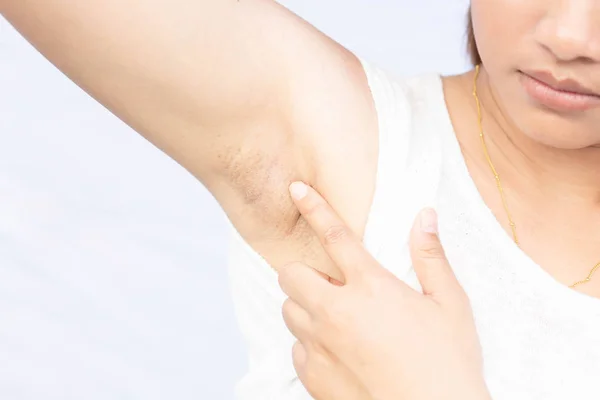 Women problem black armpit on white background for skin care and beauty concept — Stock Photo, Image