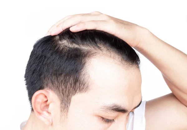 Joven hombre serio problema de pérdida de cabello para el cuidado de la salud médico y champú concepto de producto —  Fotos de Stock