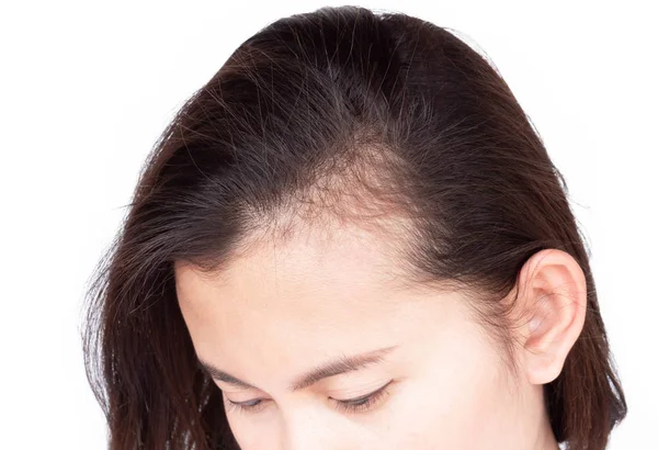 Kvinna allvarligt håravfall problem för hälso-och sjukvård schampo och skönhetsprodukt koncept, selektivt fokus — Stockfoto