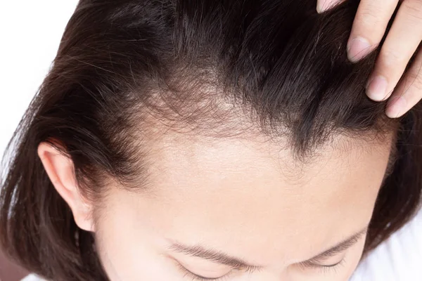 Mulher grave problema de perda de cabelo para cuidados de saúde shampoo e conceito de produto de beleza, foco seletivo — Fotografia de Stock