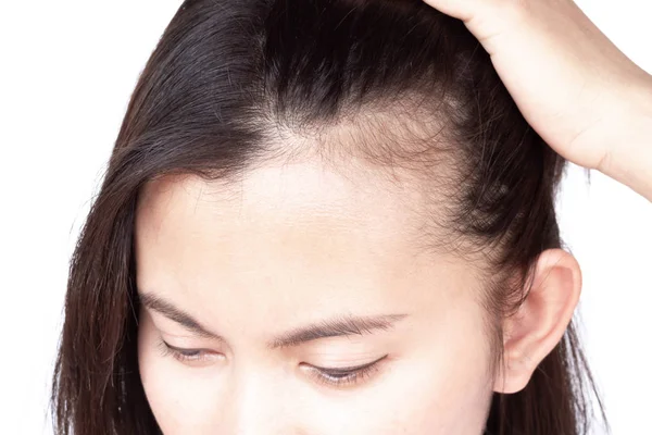 Kvinna allvarligt håravfall problem för hälso-och sjukvård schampo och skönhetsprodukt koncept, selektivt fokus — Stockfoto