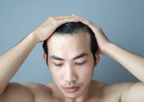 Joven hombre serio problema de pérdida de cabello para el cuidado de la salud médico y champú concepto de producto — Foto de Stock