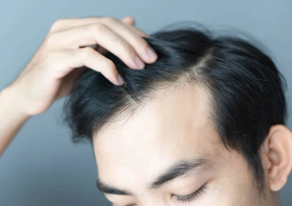 Homem jovem grave problema de perda de cabelo para cuidados de saúde médica e conceito de produto shampoo — Fotografia de Stock