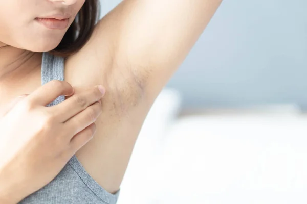 Mujer problema negro axila acostado sobre fondo de cama blanca para el cuidado de la piel y el concepto de belleza, enfoque selectivo — Foto de Stock