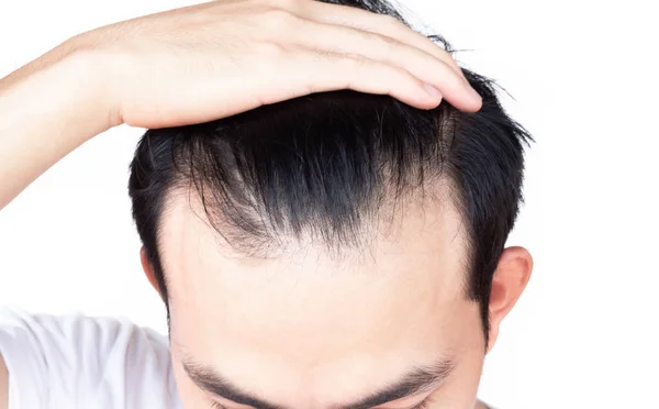Joven hombre serio problema de pérdida de cabello para el cuidado de la salud médico y champú concepto de producto — Foto de Stock