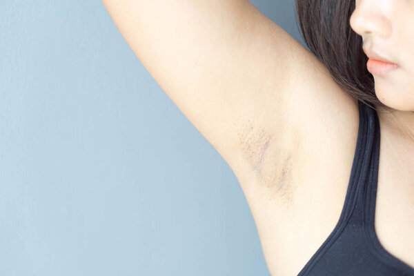 Женская проблема черные подмышки лежа на белом фоне кровати для ухода за кожей и концепция красоты, избирательный фокус
