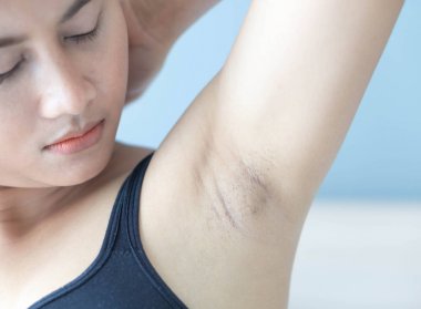 Kadın sorunu siyah koltuk altı cilt bakımı ve güzellik kavramı, seçici odak için beyaz yatak arka planda yatıyor