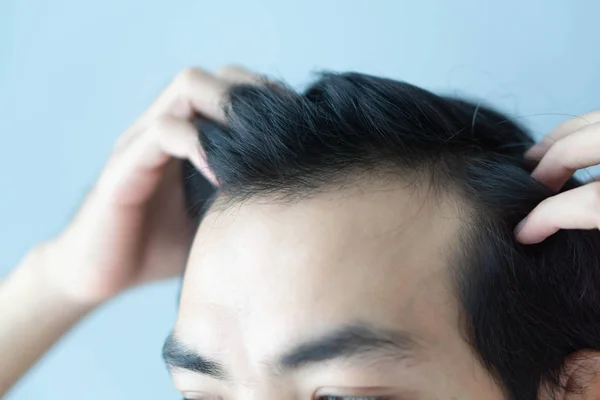 Joven hombre serio problema de pérdida de cabello para el cuidado de la salud médico y champú concepto de producto, enfoque selectivo —  Fotos de Stock