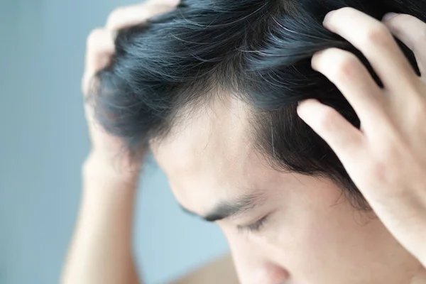 Young man serious hair loss problem for health care medical and shampoo product concept, selective focus — Stock Photo, Image