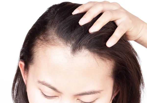 Mulher grave problema de perda de cabelo para cuidados de saúde shampoo e conceito de produto de beleza, foco seletivo — Fotografia de Stock