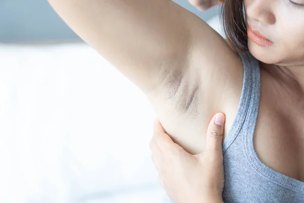 Mujer problema negro axila acostado sobre fondo de cama blanca para el cuidado de la piel y el concepto de belleza, enfoque selectivo — Foto de Stock