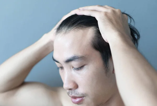 Młody człowiek poważny problem wypadania włosów dla opieki zdrowotnej medycznej i szampon koncepcji produktu, selektywne skupienie — Zdjęcie stockowe