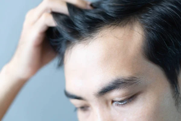 Young man serious hair loss problem for health care medical and shampoo product concept, selective focus — Stock Photo, Image