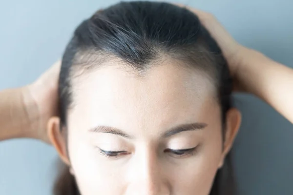 Nő súlyos hajhullás probléma egészségügyi sampon és beauwoman súlyos hajhullás probléma egészségügyi sampon és szépségápolási termék fogalmát, szelektív fókusz — Stock Fotó