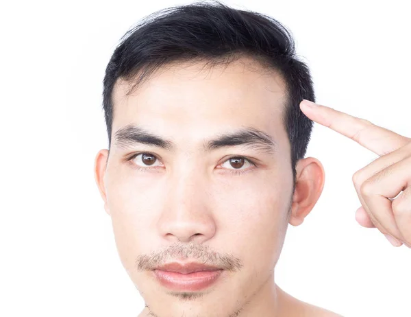 Genç adam sağlık hizmetleri tıbbi ve şampuan ürün konsepti için ciddi saç kaybı sorunu, seçici odaklanma — Stok fotoğraf