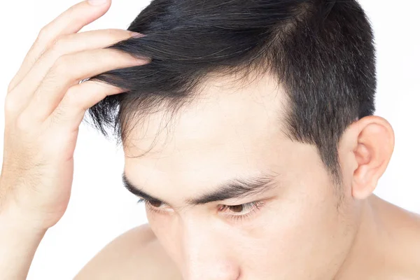 Genç adam sağlık hizmetleri tıbbi ve şampuan ürün konsepti için ciddi saç kaybı sorunu, seçici odaklanma — Stok fotoğraf