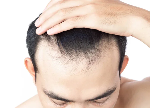 Fiatal férfi komoly hajhullás probléma az egészségügyi ellátás orvosi és sampon termék koncepció, szelektív fókusz — Stock Fotó