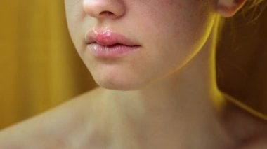 Genç bir kadının üst dudağındaki uçuklar. Herpes Labialis 'li güzel bir kadının tıbbi geçmişi. Herpes Simplex Virüsü. 