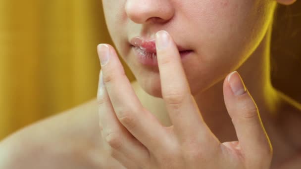 ヘルペスで彼女の上唇に軟膏を塗布する女性 ヘルペス疱疹を持つ若い美しい女性の医学的背景 ヘルペス症状の治療 — ストック動画