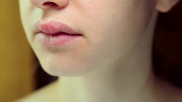 若い女性の上唇にヘルペス ハープラビリスを持つ若い美しい女性の医学的背景 単純ヘルプウイルス — ストック動画