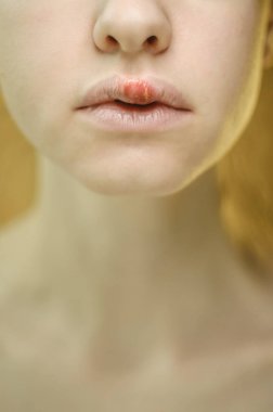 Genç bir kadının üst dudak üzerinde herpes