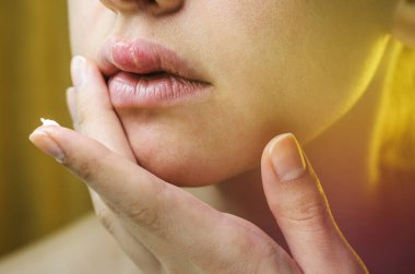 Genç bir kadının üst dudak üzerinde herpes