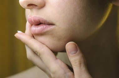 Genç bir kadının üst dudak üzerinde herpes