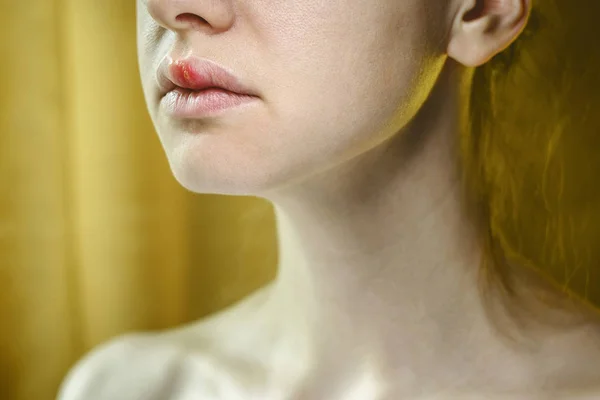 Herpes en el labio superior de una mujer joven — Foto de Stock