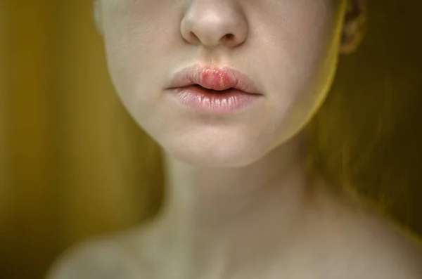 Герпес на верхней губе молодой женщины — стоковое фото