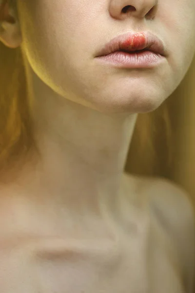 Genç bir kadının üst dudak üzerinde herpes — Stok fotoğraf