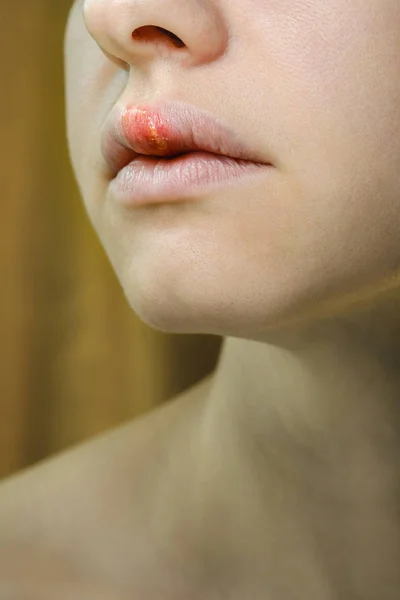 Herpes en el labio superior de una mujer joven — Foto de Stock