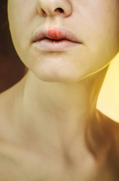 Herpes en el labio superior de una mujer joven — Foto de Stock