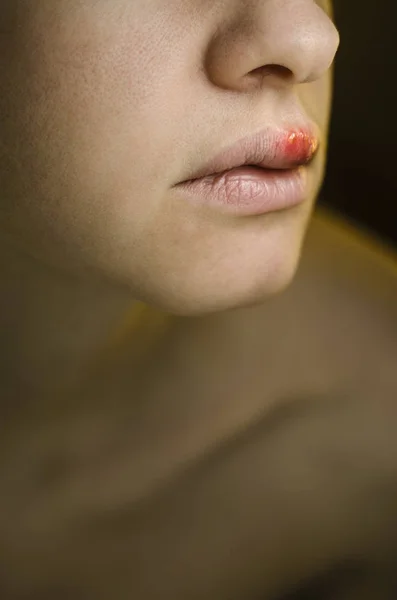 Herpes on the Upper Lip of a Young Woman