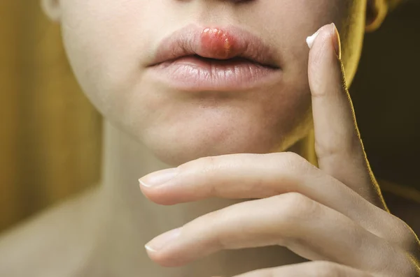 Genç bir kadının üst dudak üzerinde herpes